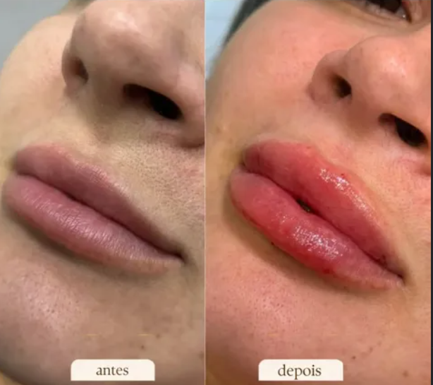 Preenchimento labial — antes e depois