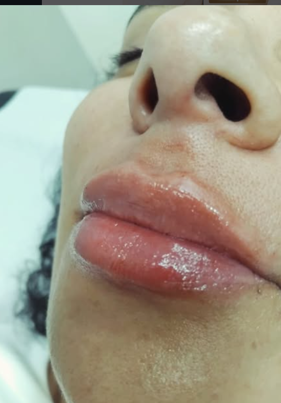 Preenchimento labial — resultado