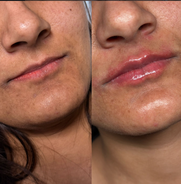 Preenchimento labial — antes e depois