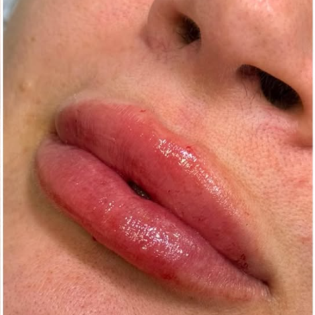 Preenchimento labial